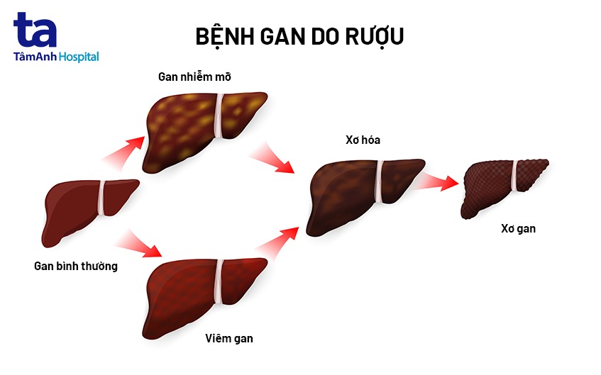 Bệnh Gan Do Rượu