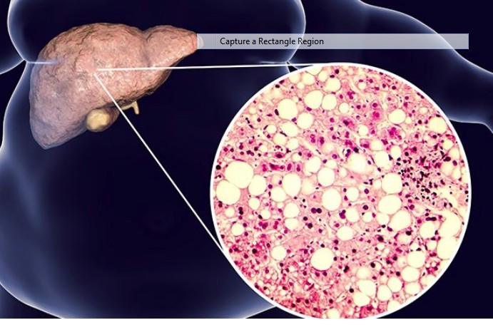 Bệnh Gan Nhiễm Mỡ