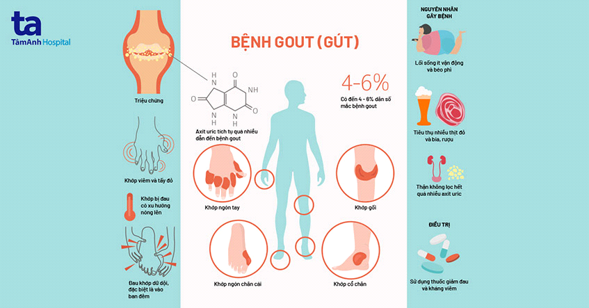 Bệnh Gút (Gout)