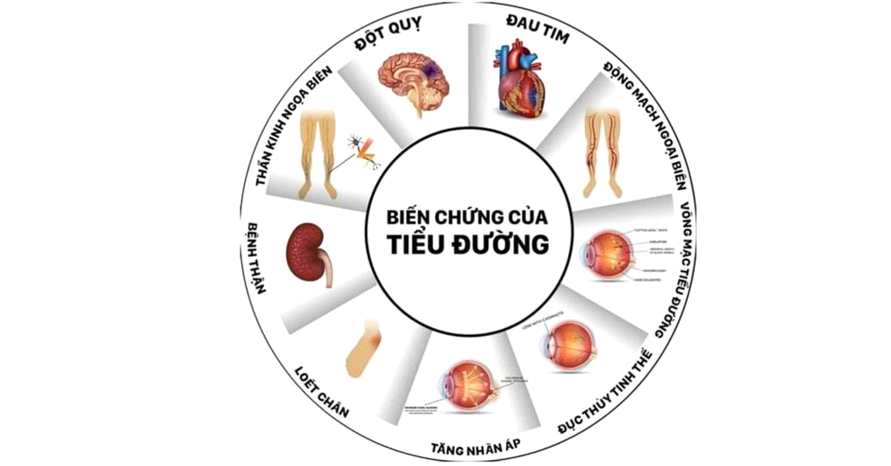 Tiểu Đường Type 2 (Đái Tháo Đường)