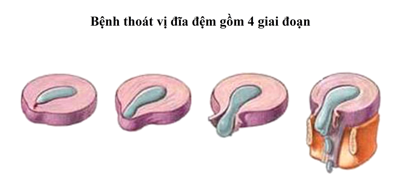 Thoát Vị Đĩa Đệm Cột Sống