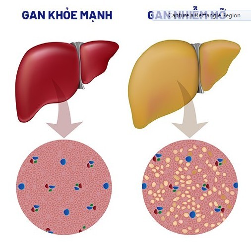 Gan Nhiễm Mỡ