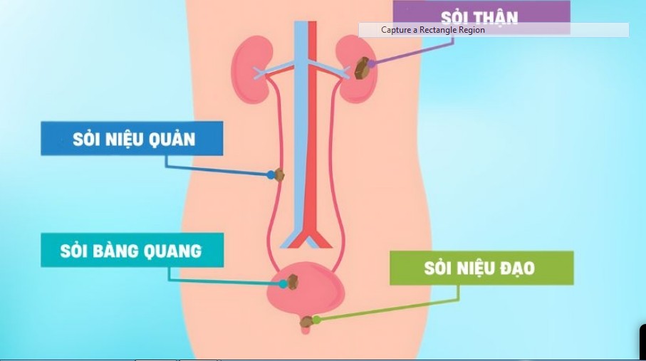 Phân Loại Sỏi Tiết Niệu Theo Vị Trí