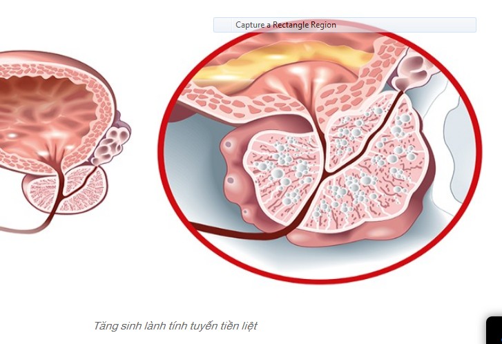 Tăng Sinh Lành Tính Tuyến Tiền Liệt