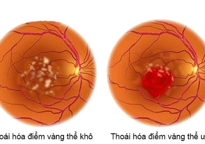 Thoái Hóa Điểm Vàng Mắt