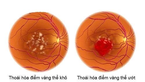 Thoái Hóa Điểm Vàng Mắt