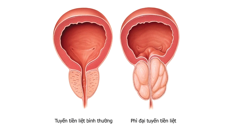 U Xơ Tuyến Tiền Liệt