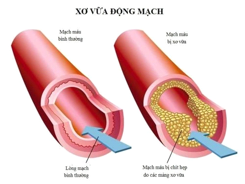 Xơ Cứng Mạch Máu